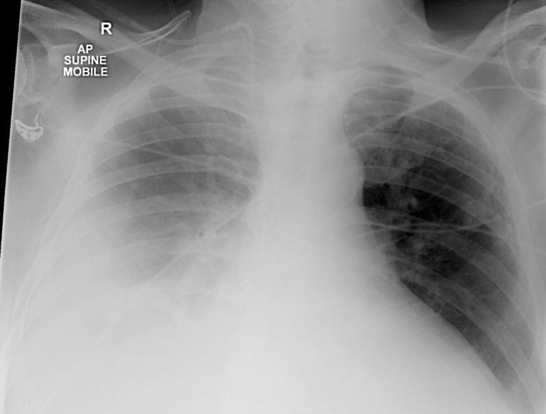 Chest X Ray Approach To The Cxr Lungs