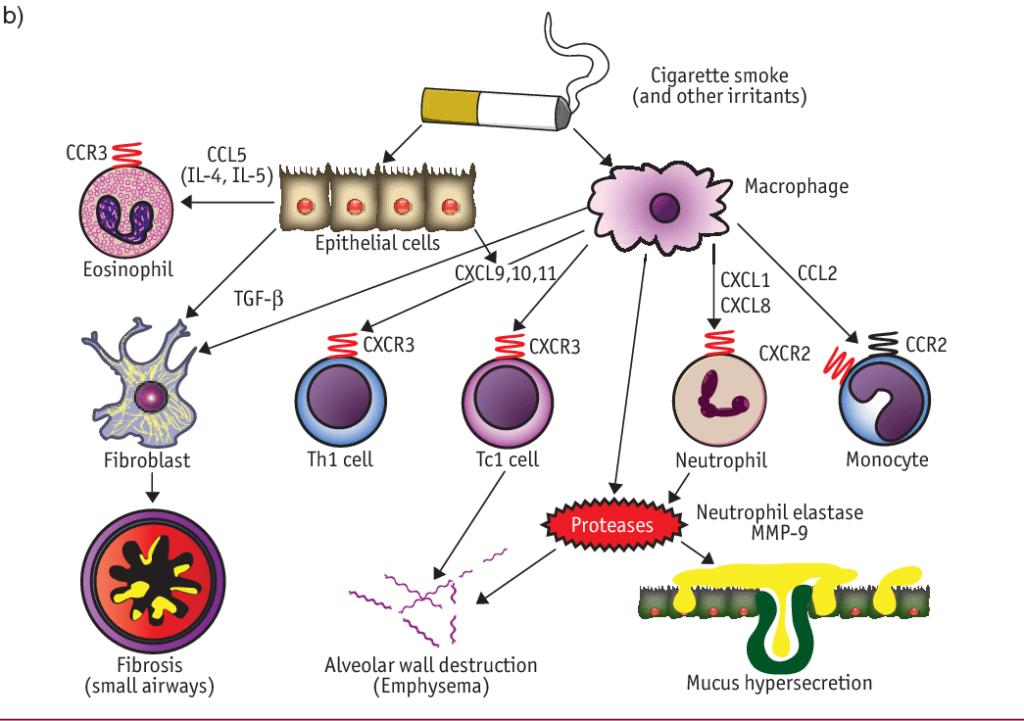 Smoking Cigarettes Pathophysiology Lungs