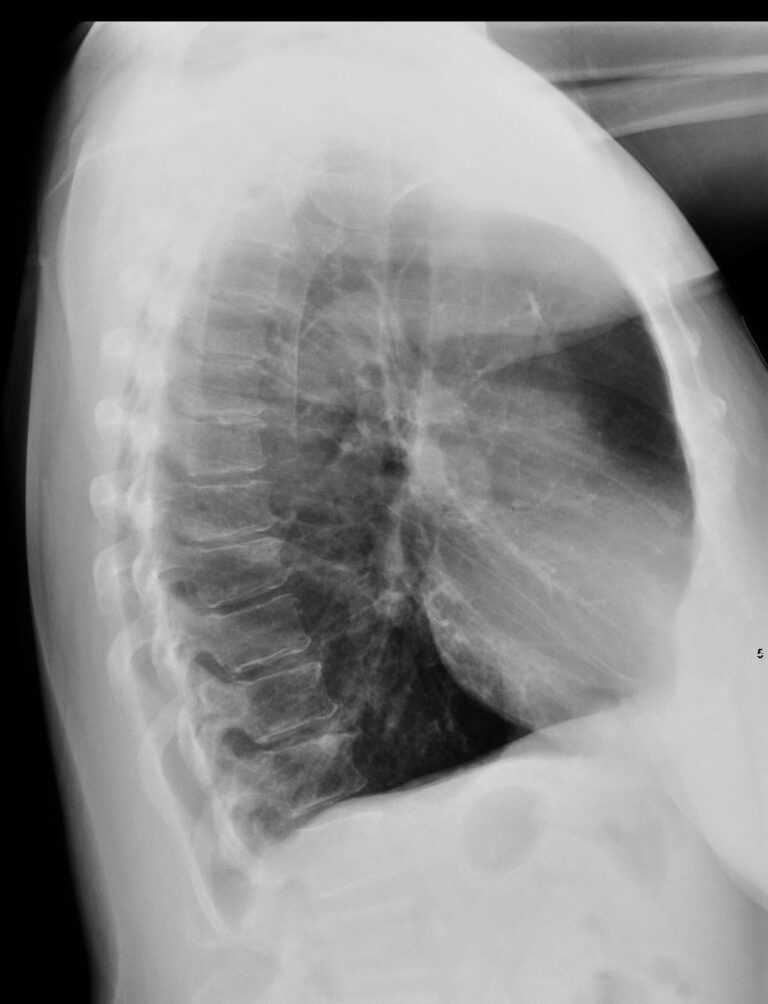 Cxr In Emphysema Lungs