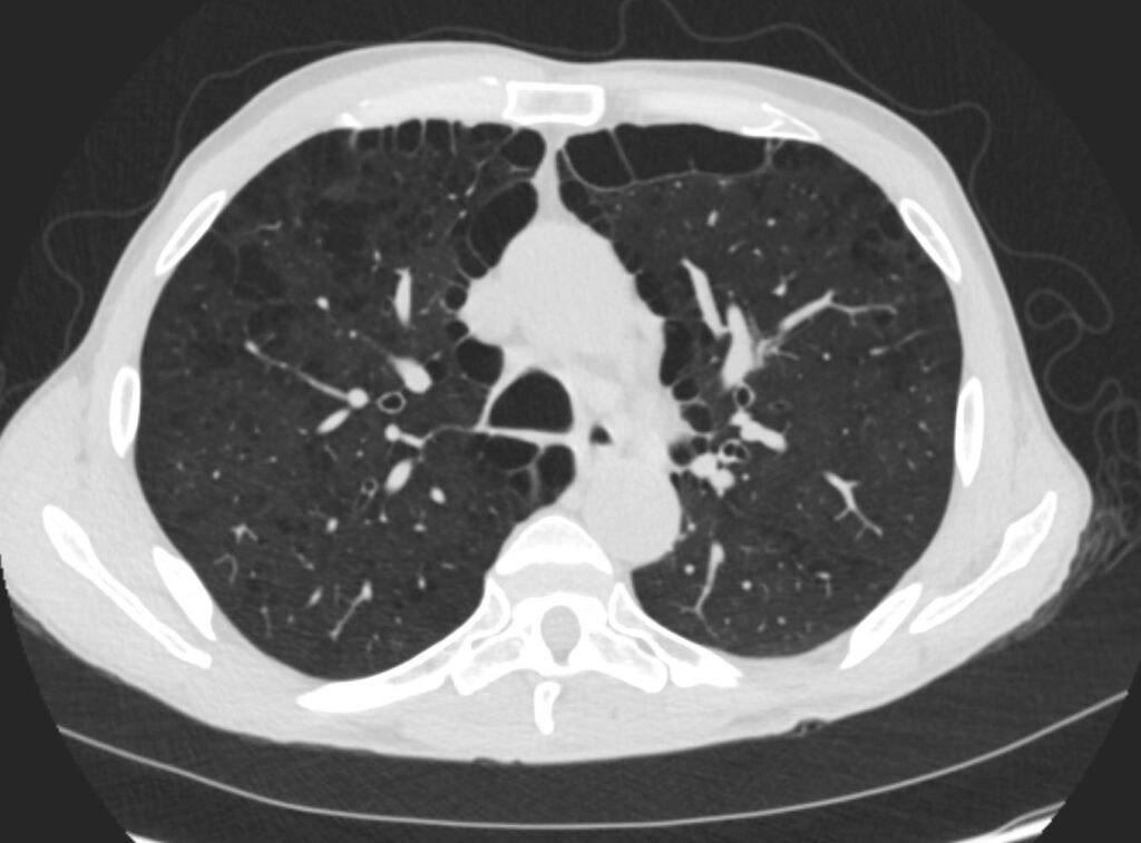 Faces Of Paraseptal Emphysema Lungs