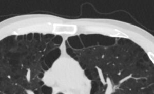 Faces Of Paraseptal Emphysema Lungs