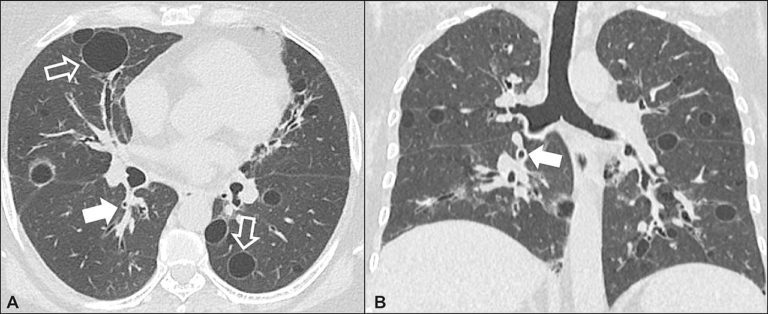 Lymphocytic Interstitial Pneumonia, LIP | Lungs