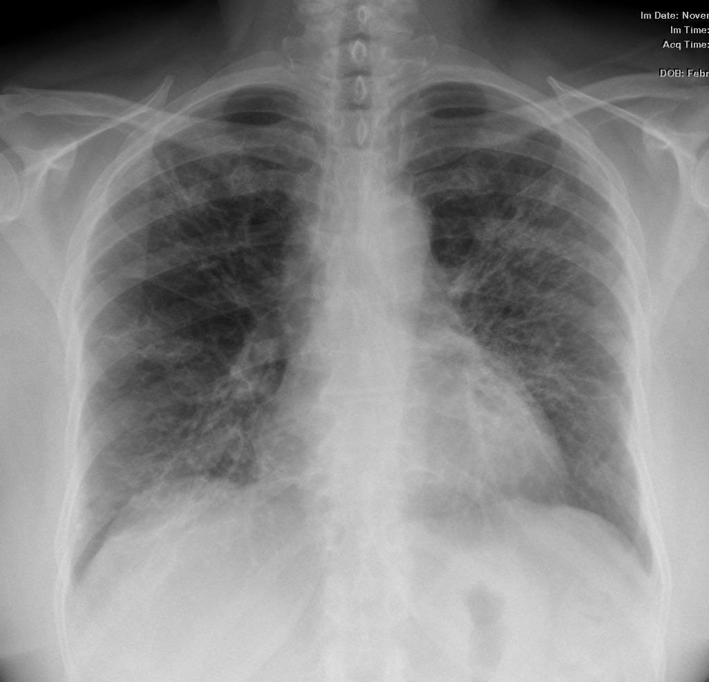 000 Usual Interstitial Pneumonia, UIP | Lungs