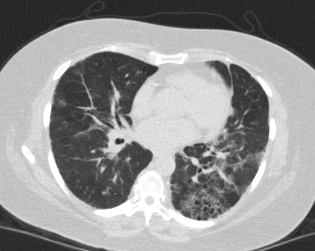 000 Honeycomb Lung | Lungs