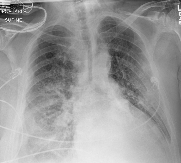 Trachea | Lungs