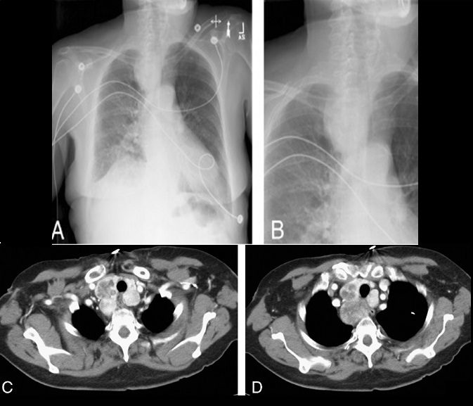 Pathogens | Free Full-Text | Chest Imaging for Pulmonary TB—An Update