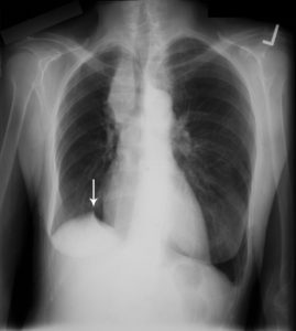 Juxtaphrenic peak sign | Lungs