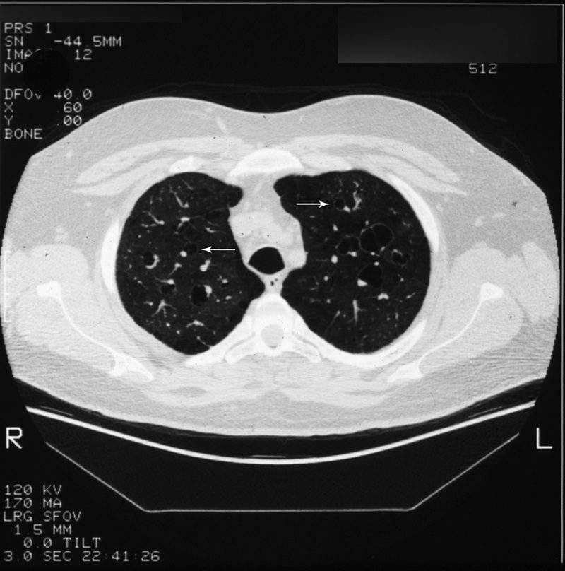 Diagnostic imaging in adult non-cystic fibrosis bronchiectasis | European  Respiratory Society