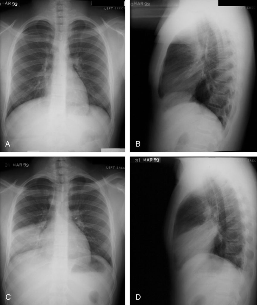 Silhouette sign | Lungs