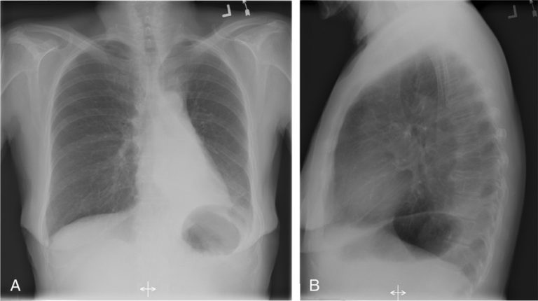 Signs And Findingsof Atelectasis Lungs