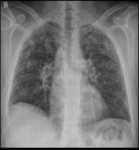 Interstitial Pneumonias, ILD | Lungs