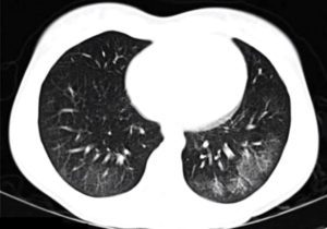 Ground Glass Infiltrates and Opacities – Introduction | Lungs