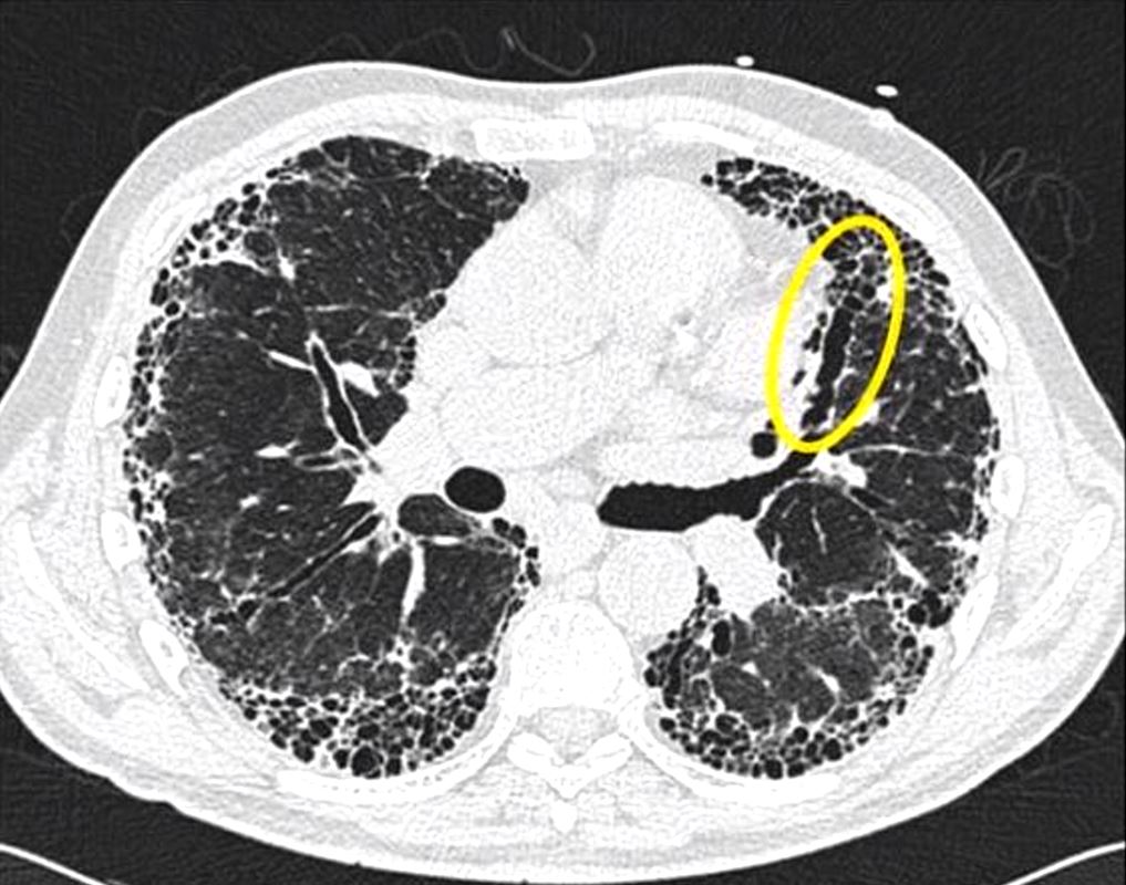 Non-specific interstitial pneumonia: findings on sequential CT scans of  nine patients | Thorax