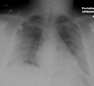 000 Wegener’s granulomatosis with polyangiitis, GPA | Lungs