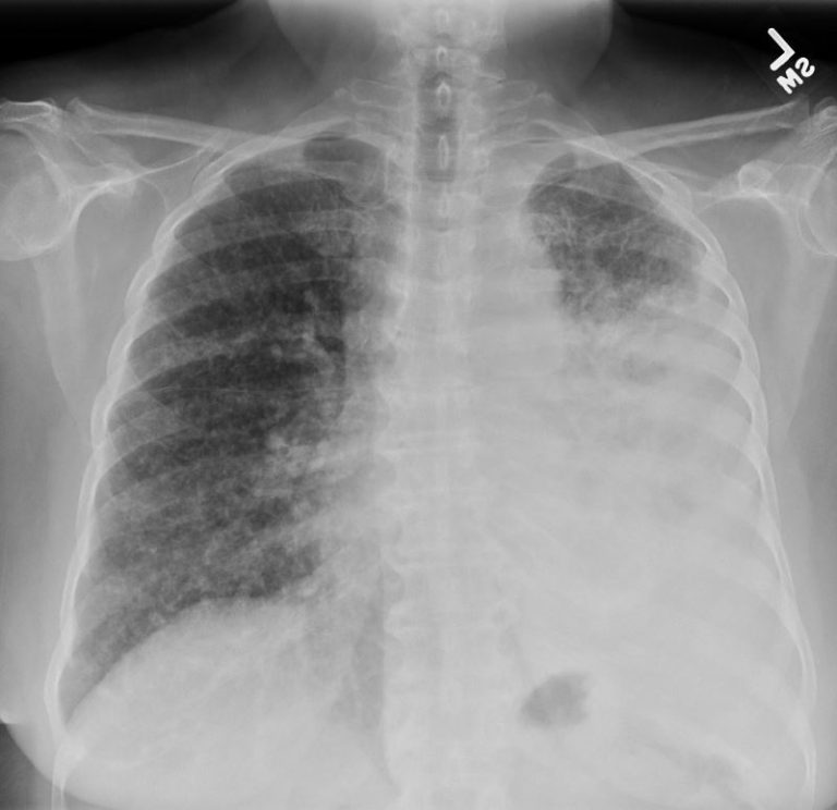 000 Fissures of the Lung | Lungs