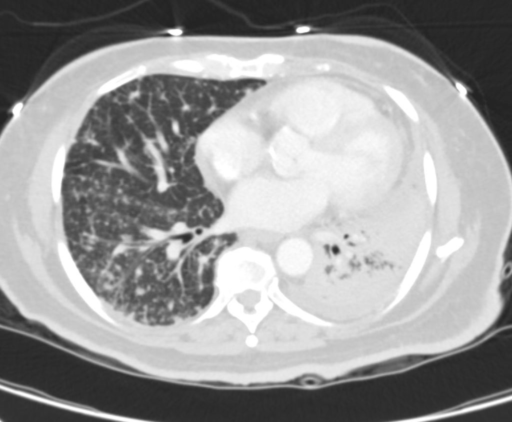 000 Fissures of the Lung | Lungs