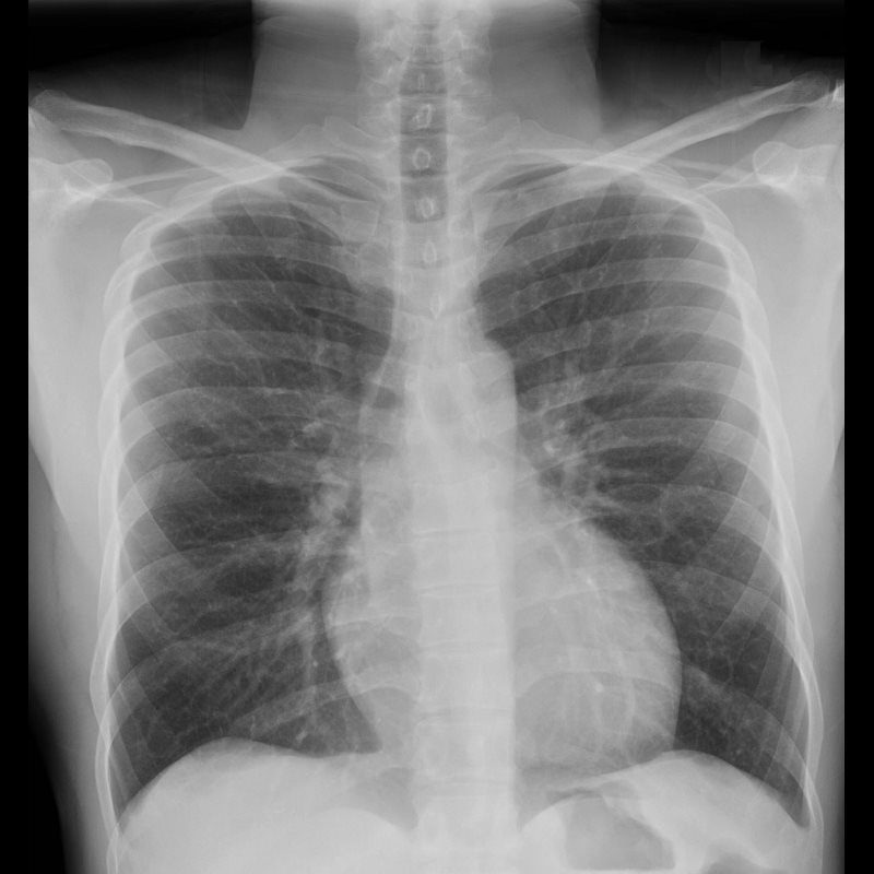 walking pneumonia x ray