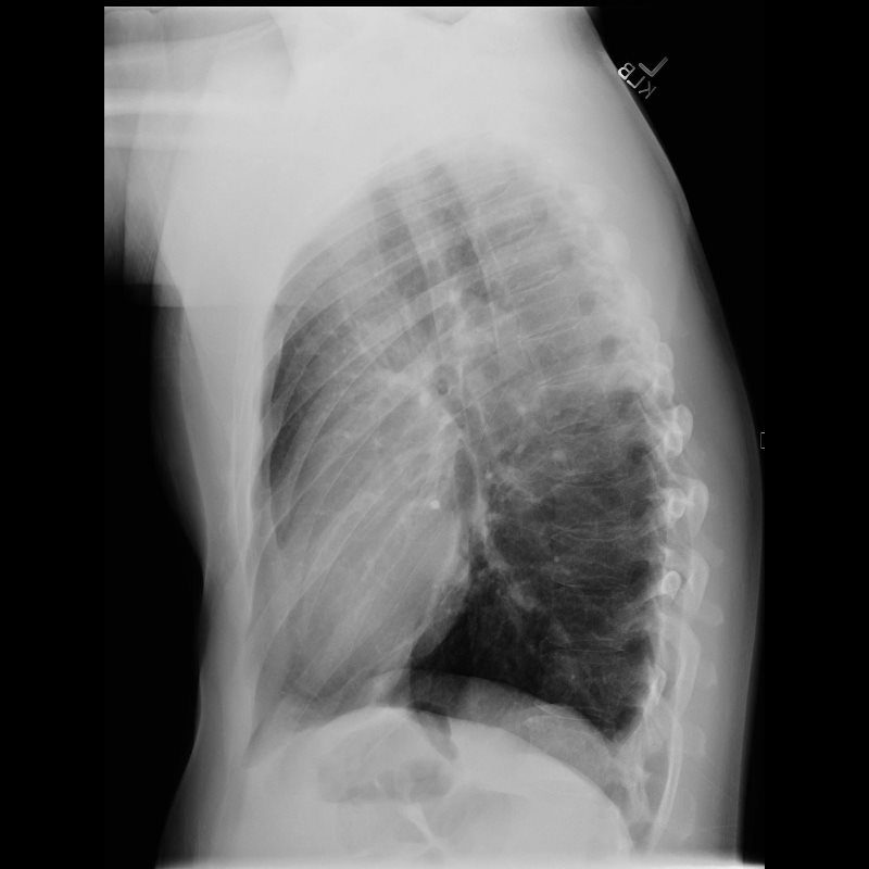 chest x ray double pneumonia