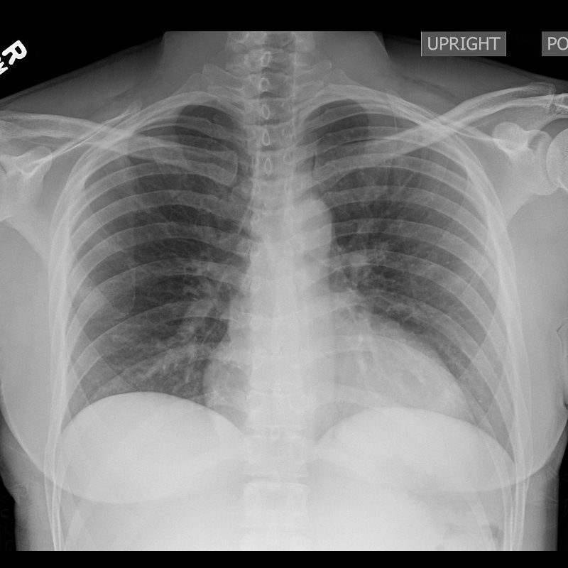 Chest X ray Normal CXR | Lungs