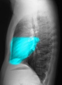 Chest X Ray, lung parts and fissures, CXR | Lungs