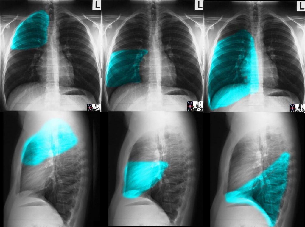 Chest X-ray, Approach to the CXR | Lungs