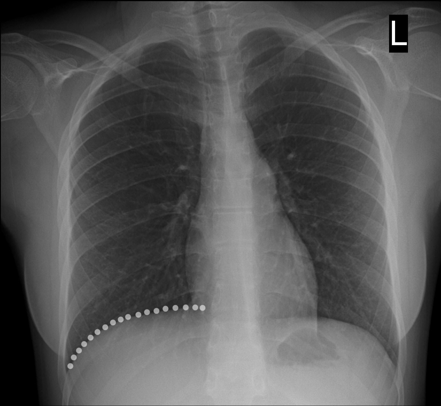 Chest X Ray Approach To The Cxr Lungs
