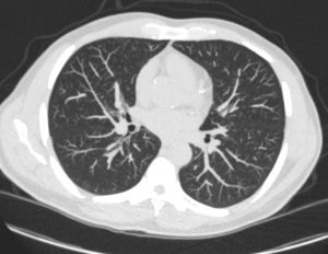 Pulmonary Veins 