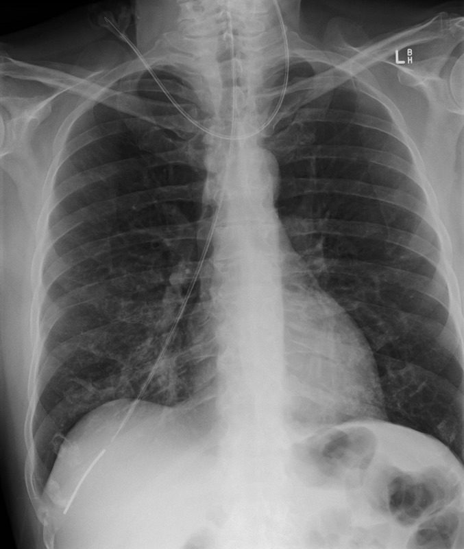 Chest X Ray Lung Parts And Fissures Cxr Lungs