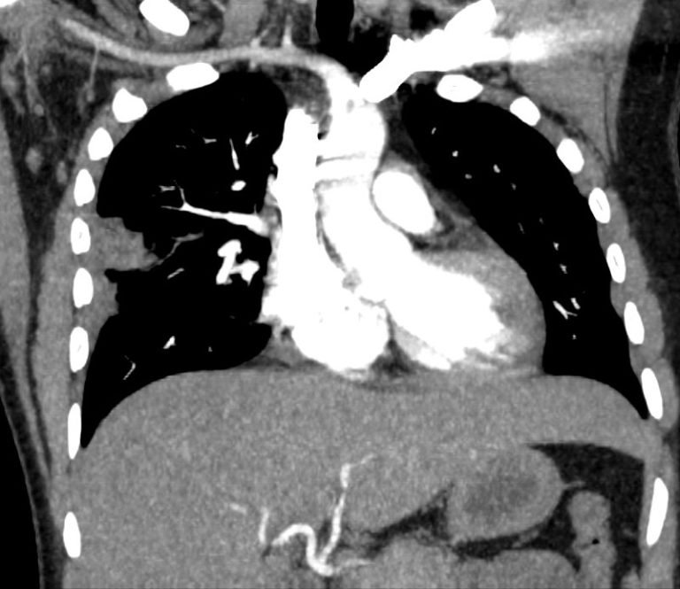 000 Reversed Halo Sign Atoll Sign | Lungs