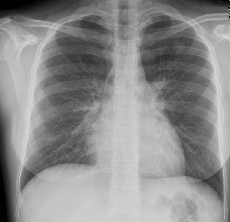 007Lu Acute Histoplasmosis | Lungs