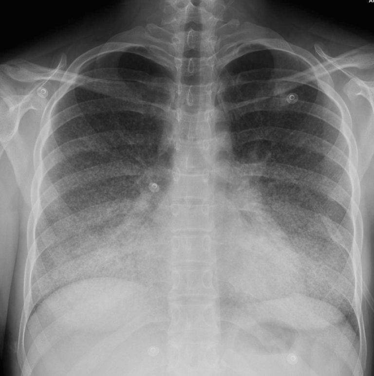 007Lu Acute Histoplasmosis | Lungs