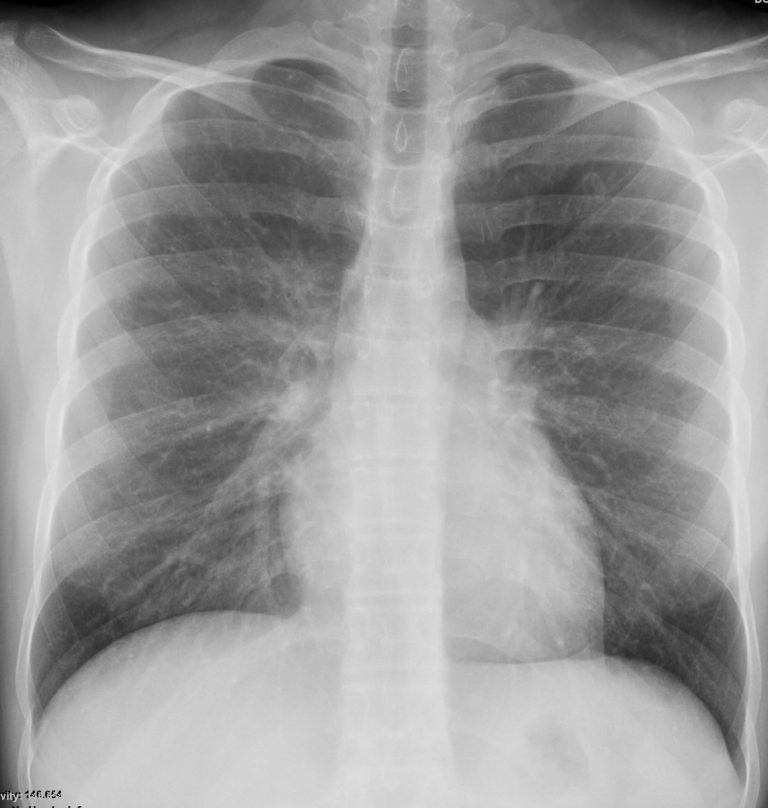 007Lu Acute Histoplasmosis | Lungs