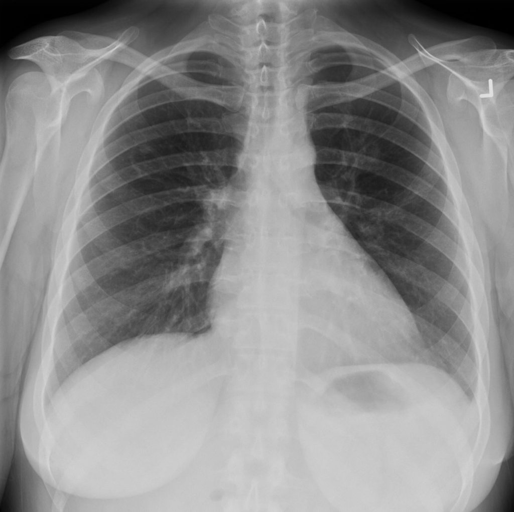 004Lu Wegener’s with Central Cavitation | Lungs