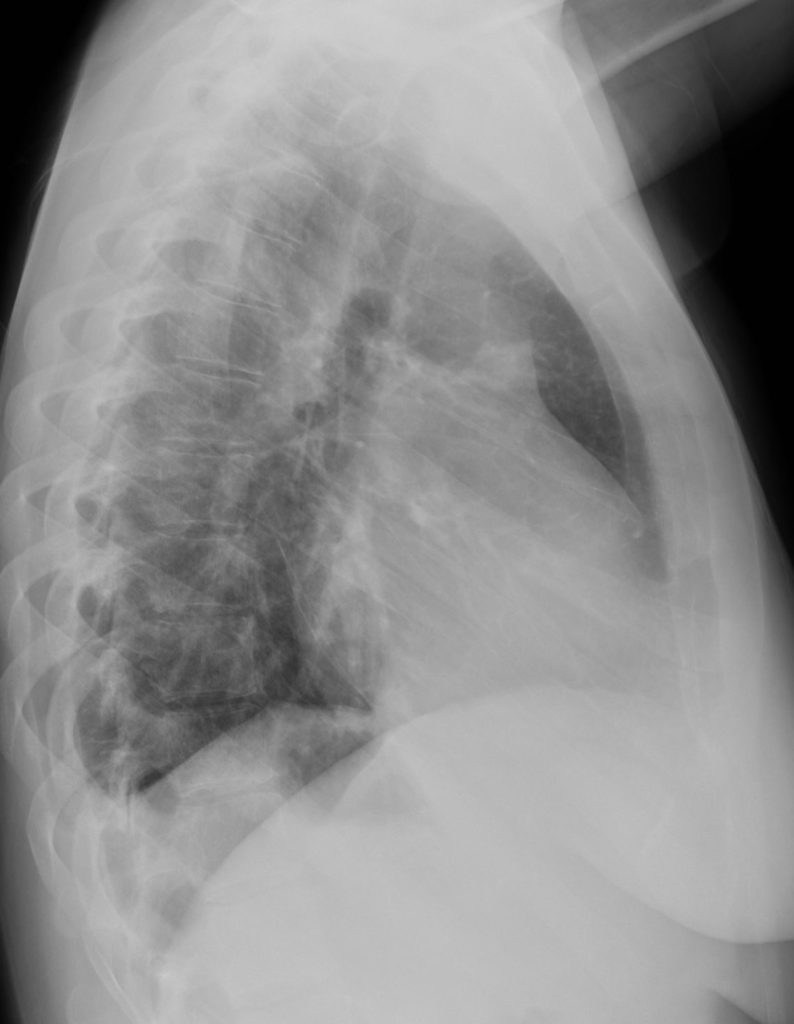 004Lu Wegener’s with Central Cavitation | Lungs