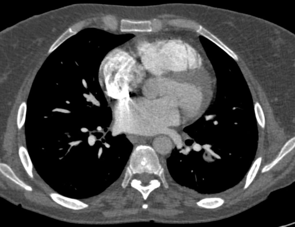 004Lu Wegener’s with Central Cavitation | Lungs