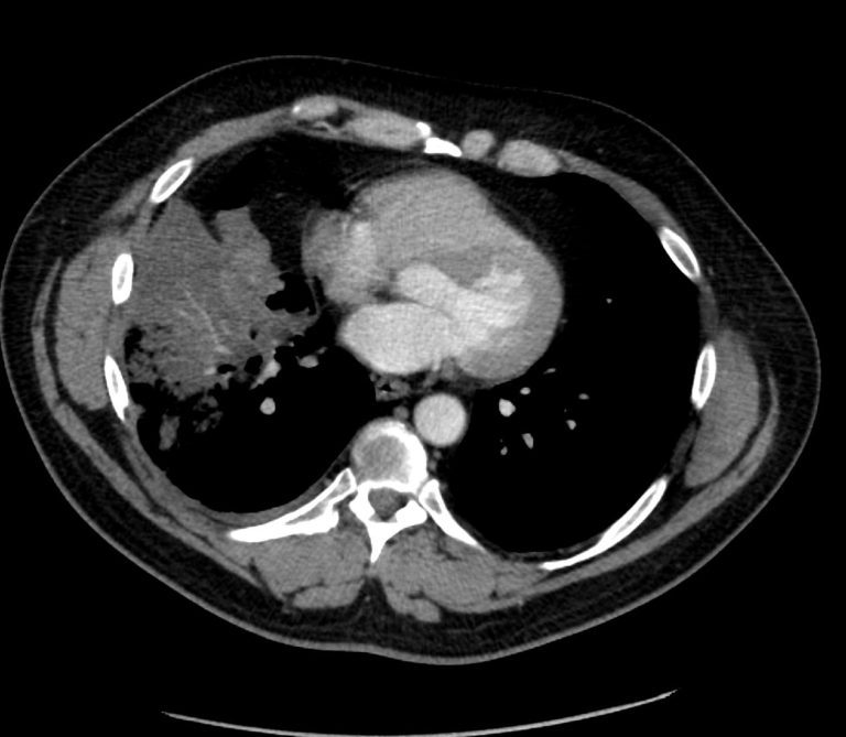 011Lu Pneumonic Mucinous Adenocarcinoma | Lungs