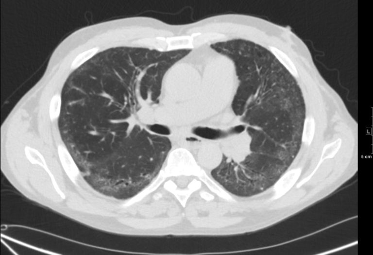 000 Nonspecific Interstitial Pneumonia, NSIP | Lungs