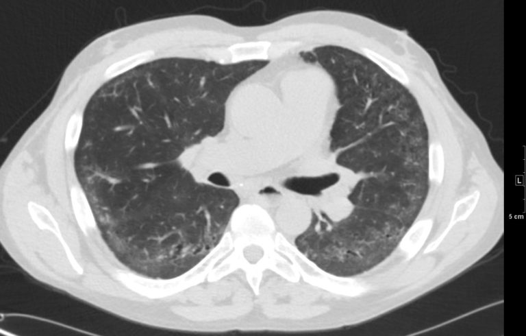 000 Nonspecific Interstitial Pneumonia, NSIP | Lungs