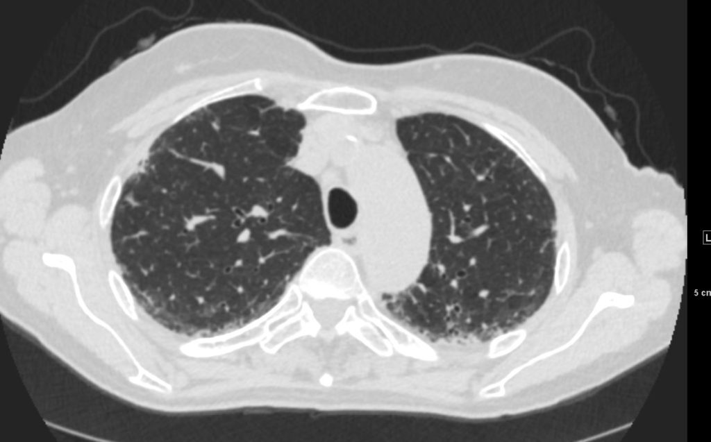 000 Scleroderma | Lungs