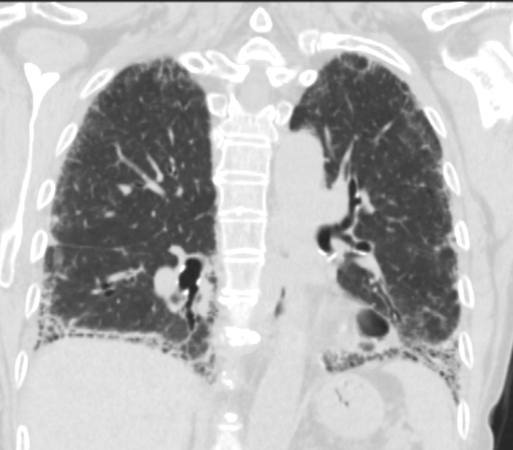 000 Scleroderma | Lungs