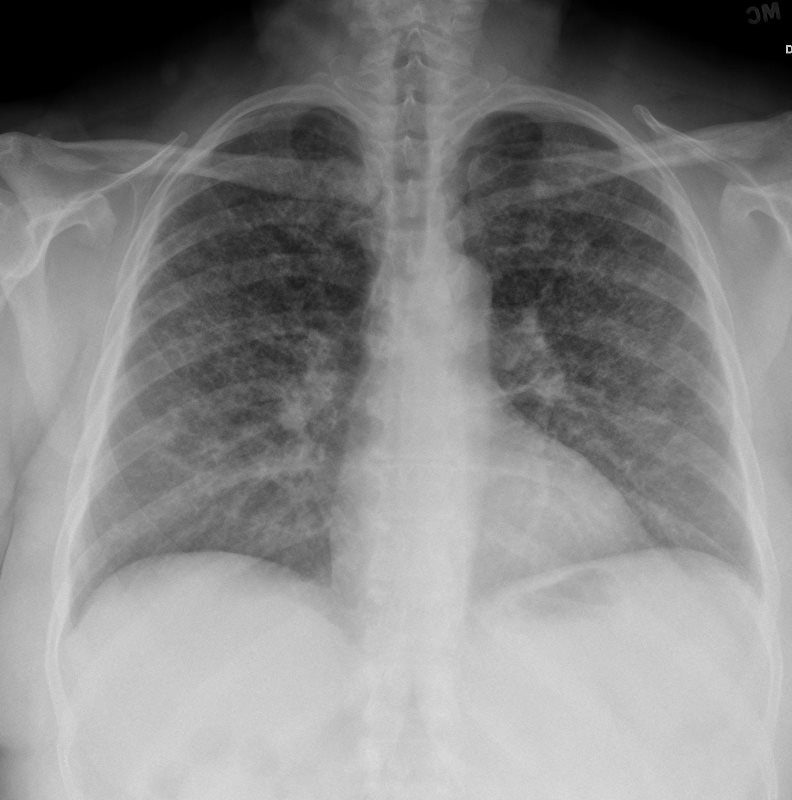 CXR Reticulonodular Pattern Lungs