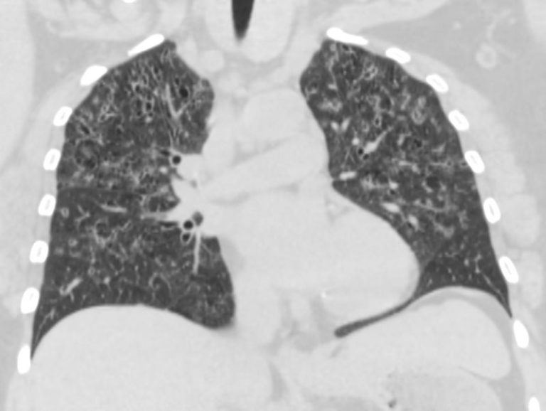 CXR Reticulonodular Pattern Lungs