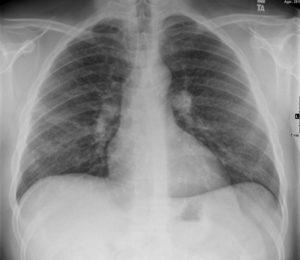 000 Pulmonary Langerhans Cell Histiocytosis | Lungs