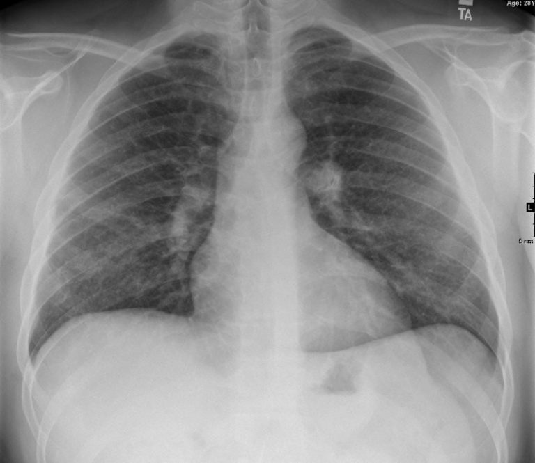 000 Pulmonary Langerhans Cell Histiocytosis | Lungs