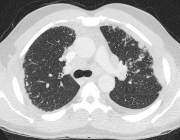 Sarcoidosis – Nodules and Micronodules | Lungs