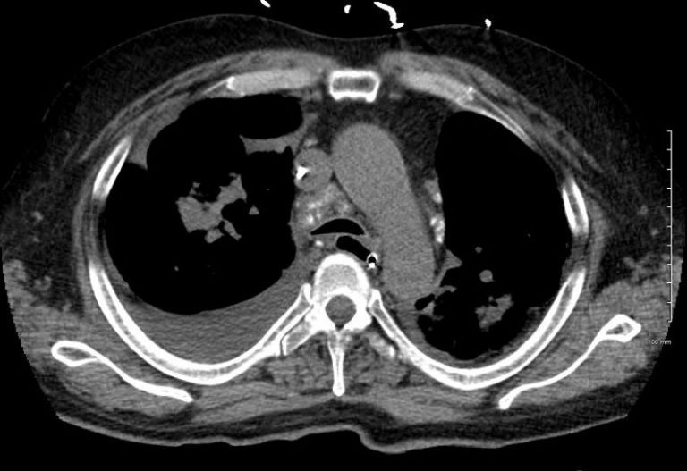 Faces of Calcified Mediastinal Nodes | Lungs