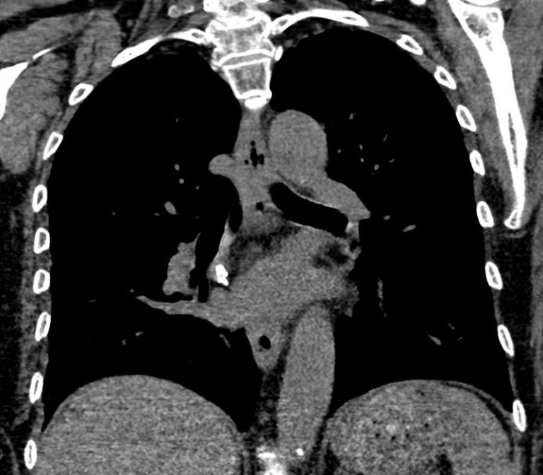 038Lu Amyloidosis Hilar Lymph Nodes Pericardium CAD | Lungs