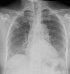 039LU TB Cavitation Pre and Post Rx | Lungs