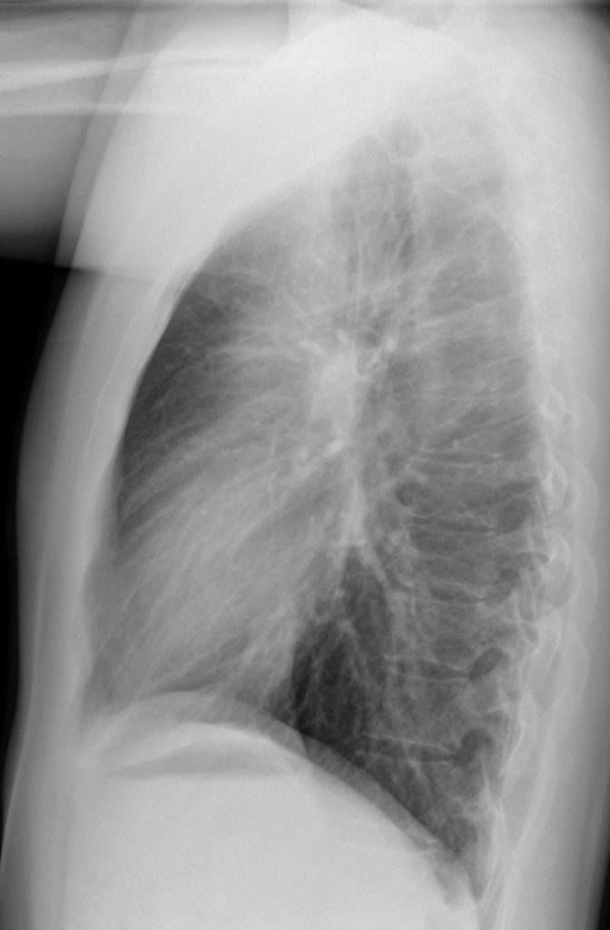 034Lu Basal Bronchitis Bronchiectasis Young Female | Lungs