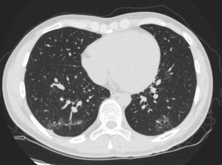 034Lu Basal Bronchitis Bronchiectasis Young Female | Lungs